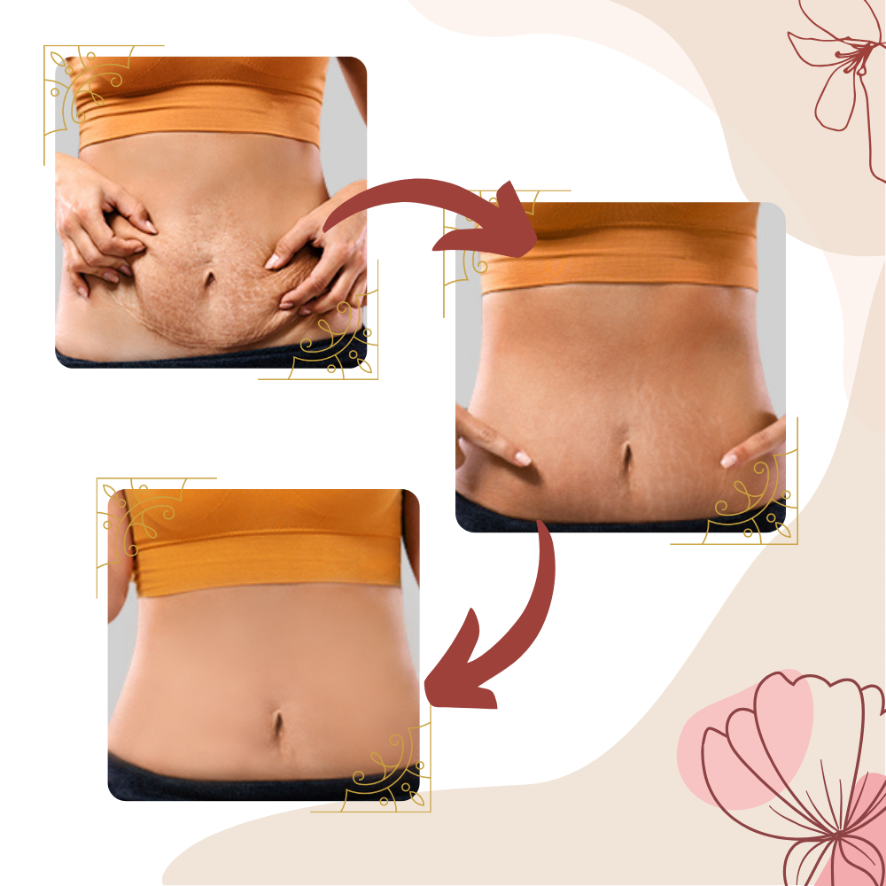 Cellulitis-massageapparat med højfrekvent vibration - Ozerty