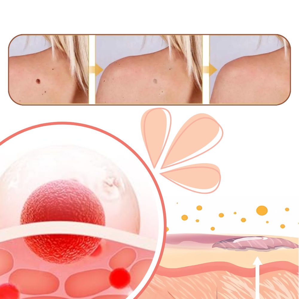 Ikke-invasiv fjernelse af hudmærker - Ozerty