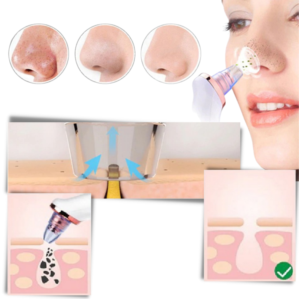 Blackhead pore renser - Ozerty