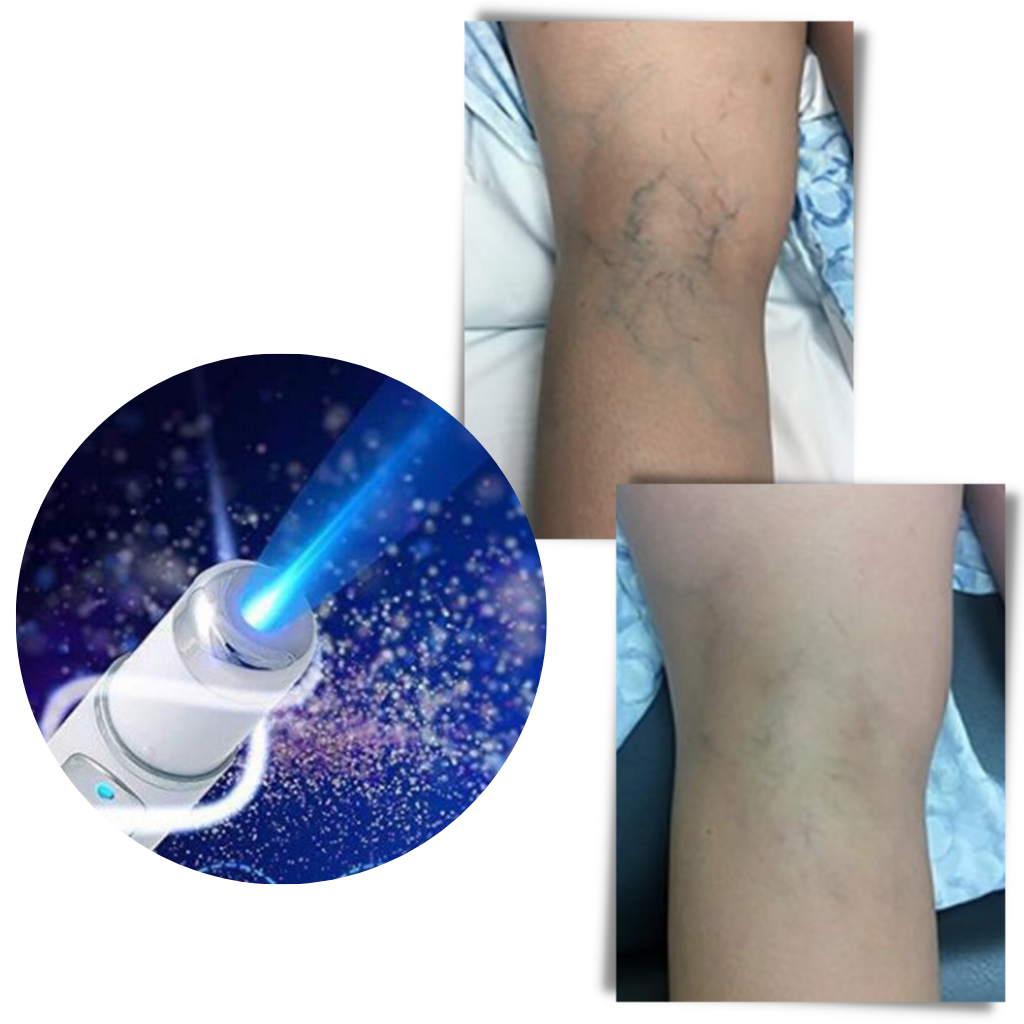 Blåt lys hud terapi pen - Ozerty