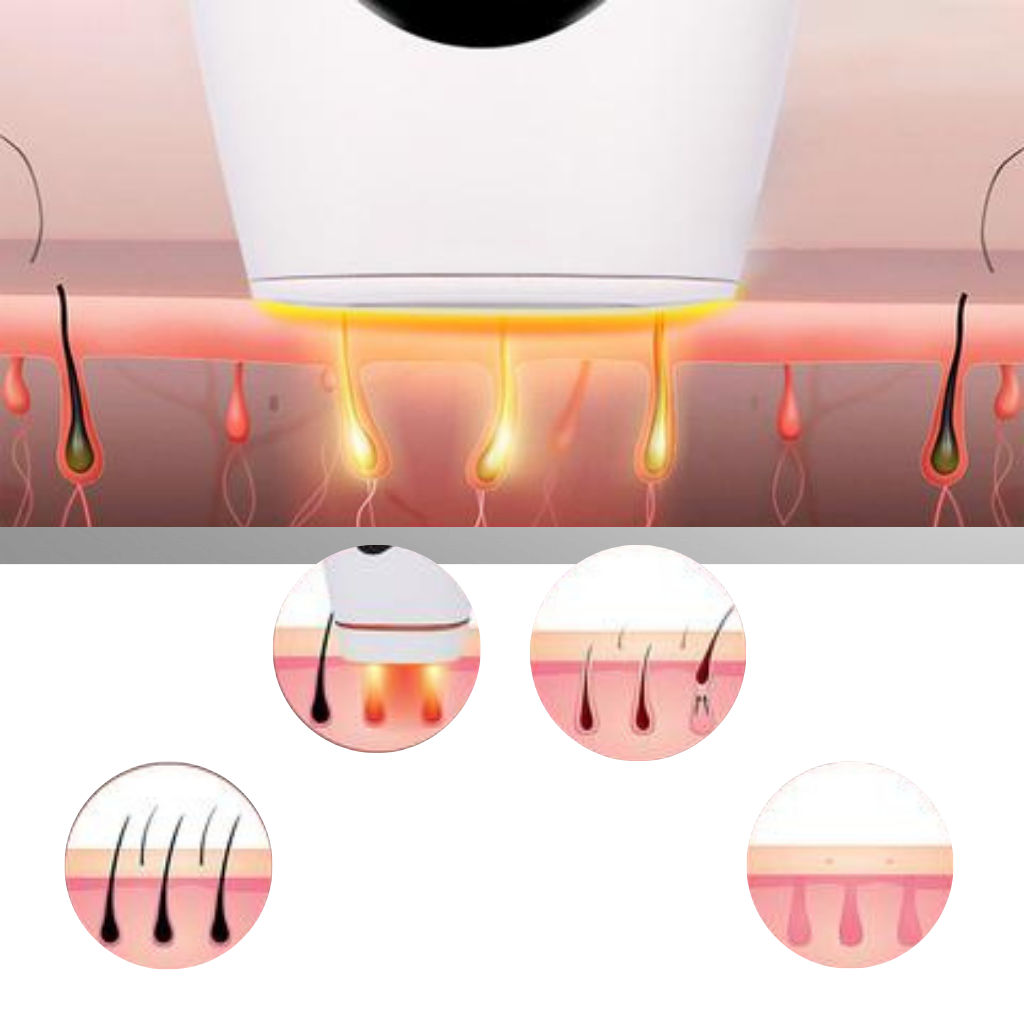 IPL laser hårfjerner håndsæt - Ozerty