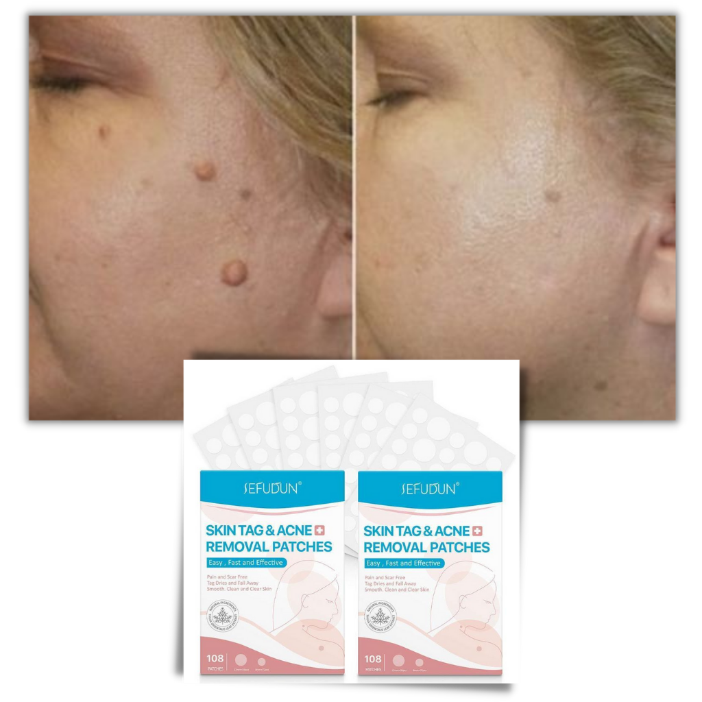 Behandlingspatch til fjernelse af udmærker - Ozerty